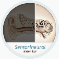 sensorineural loss inner ear